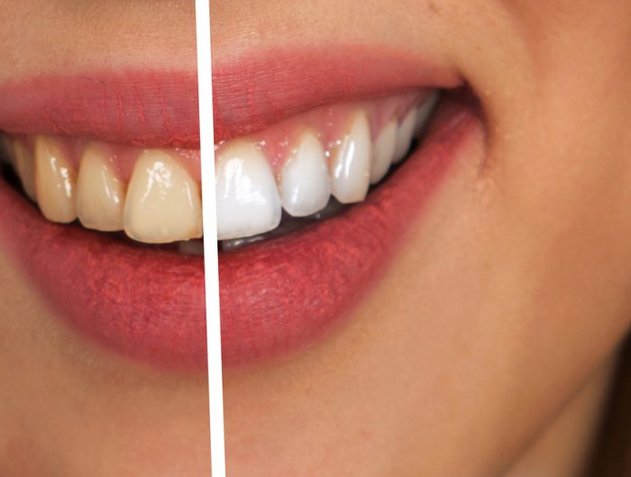is giftig: gebruik jij al tandpasta zonder fluoride?